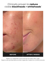 Travel Size 2% BHA Liquid Exfoliant